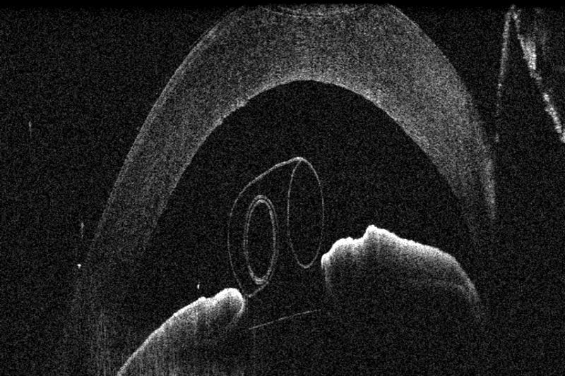 DMEK_Anterior_main_picture DMEK_Anterior_main_picture