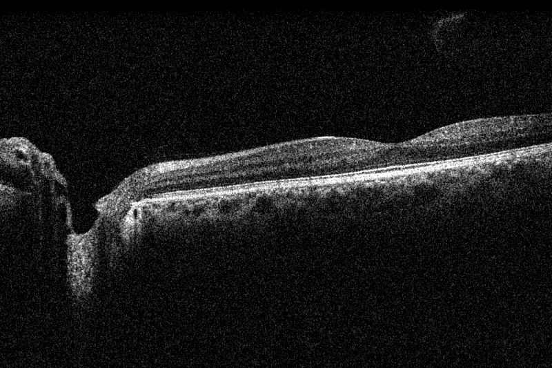 Retina_posterior_main_picture Retina_posterior_main_picture